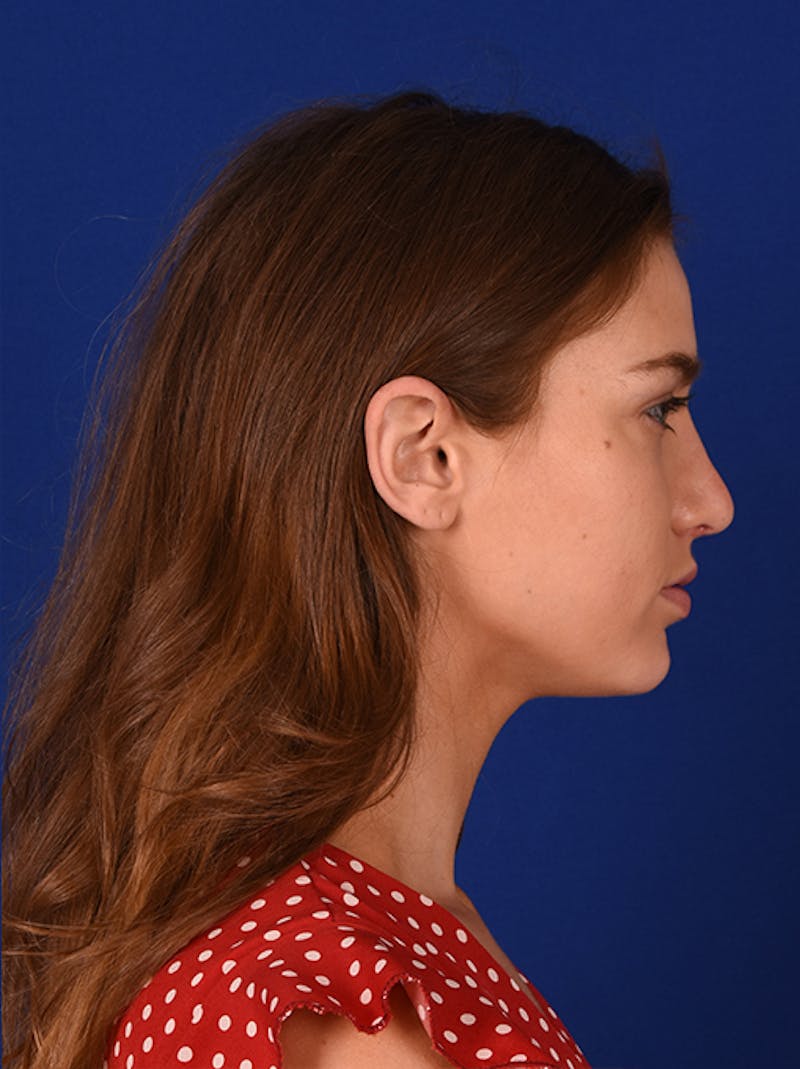 Female Rhinoplasty Before & After Gallery - Patient 17363989 - Image 6