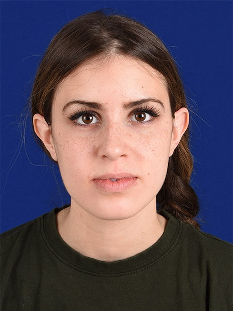 Female Rhinoplasty Before & After Gallery - Patient 17363990 - Image 1