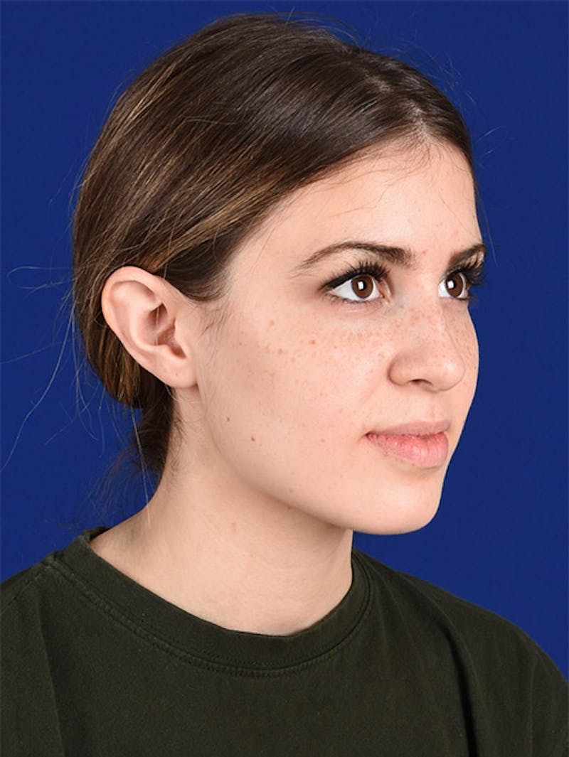 Female Rhinoplasty Before & After Gallery - Patient 17363990 - Image 3