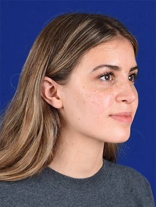 Female Rhinoplasty Before & After Gallery - Patient 17363990 - Image 4