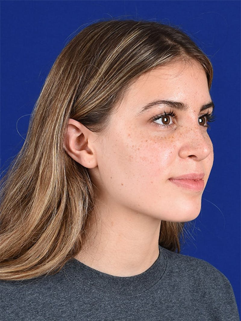 Female Rhinoplasty Before & After Gallery - Patient 17363990 - Image 4