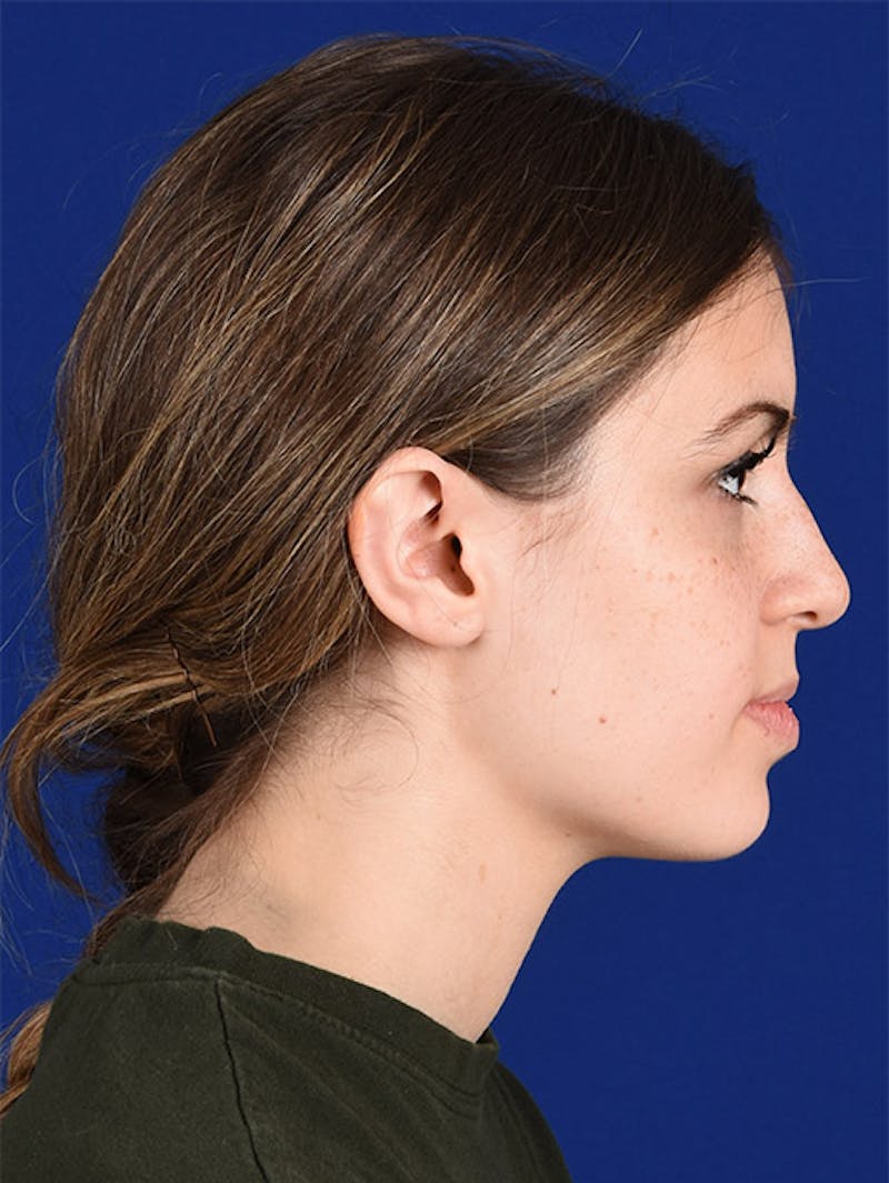 Female Rhinoplasty Before & After Gallery - Patient 17363990 - Image 5