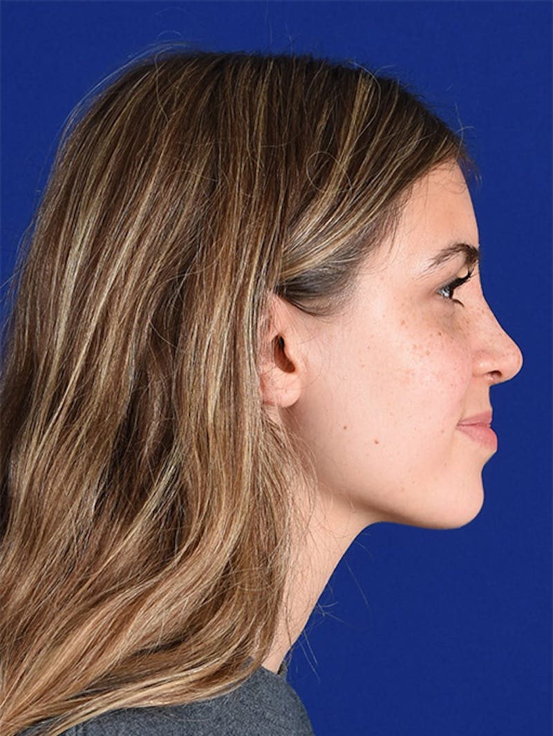 Female Rhinoplasty Before & After Gallery - Patient 17363990 - Image 6