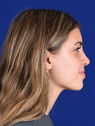 Female Rhinoplasty Before & After Gallery - Patient 17363990 - Image 6