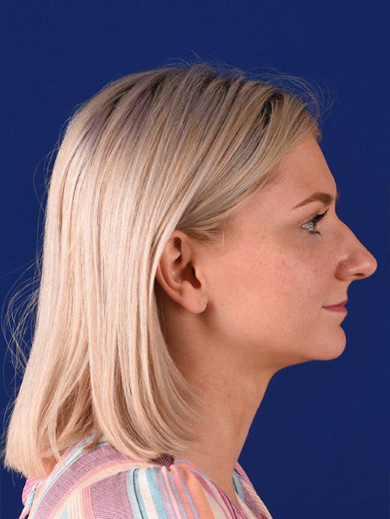 Female Rhinoplasty Before & After Gallery - Patient 17363993 - Image 5