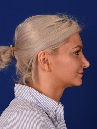 Female Rhinoplasty Before & After Gallery - Patient 17363993 - Image 6