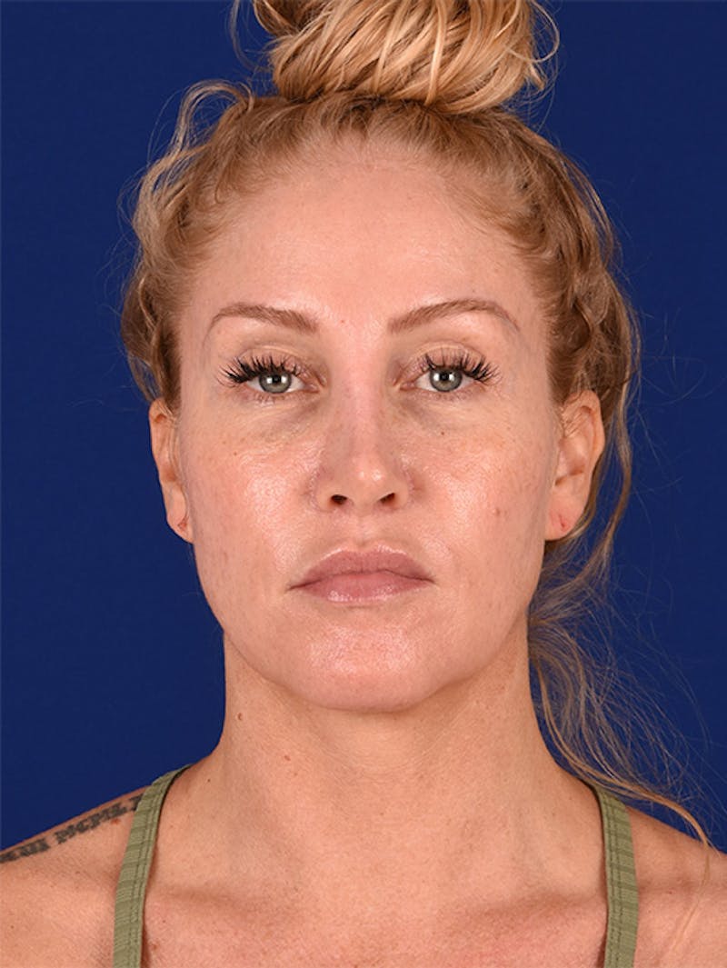 Female Rhinoplasty Before & After Gallery - Patient 17363995 - Image 2