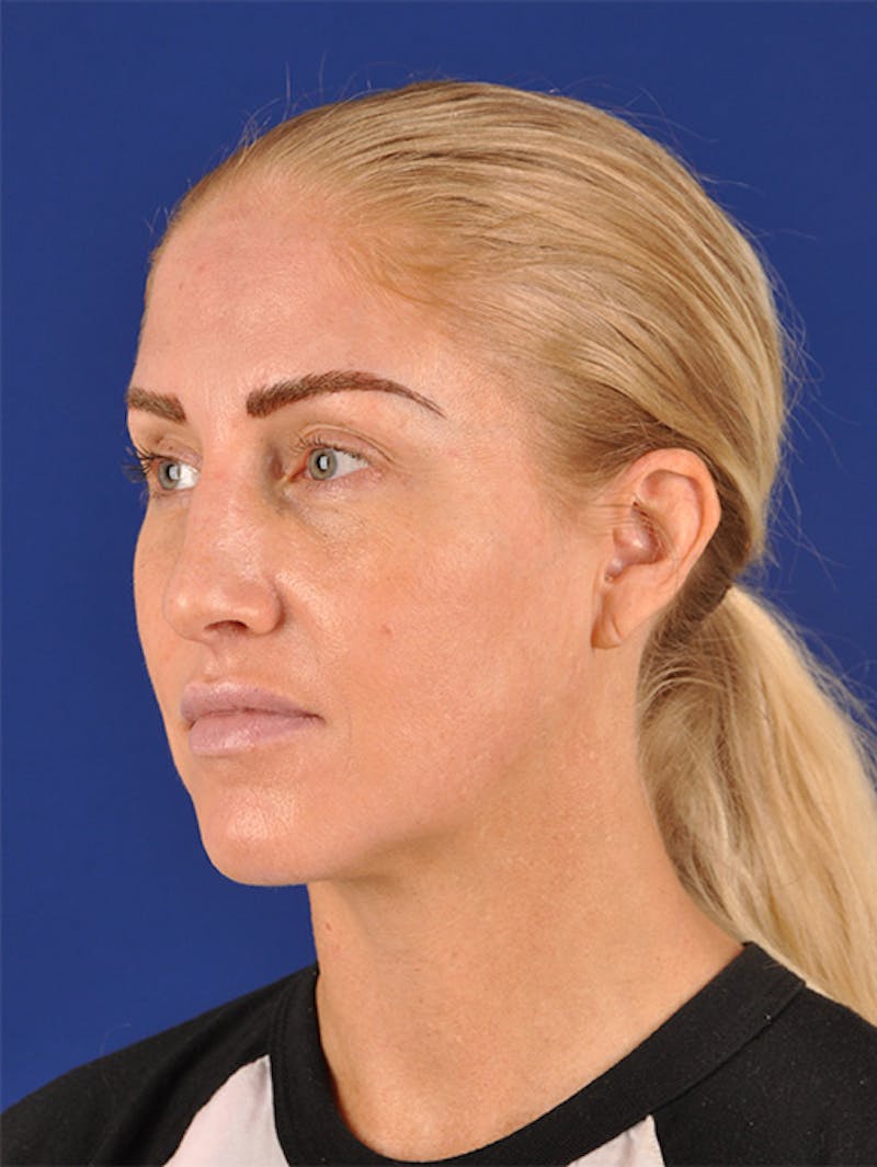 Female Rhinoplasty Before & After Gallery - Patient 17363995 - Image 3