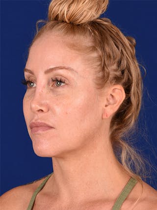 Female Rhinoplasty Before & After Gallery - Patient 17363995 - Image 4