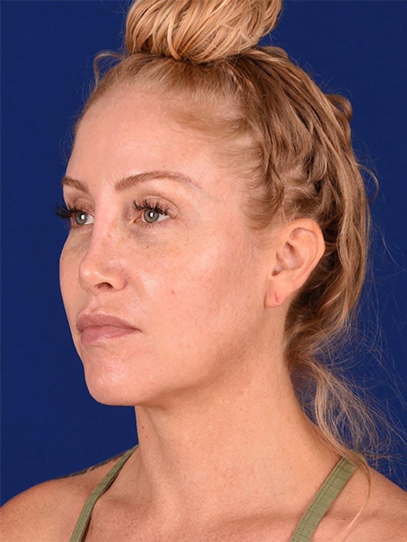 Female Rhinoplasty Before & After Gallery - Patient 17363995 - Image 4