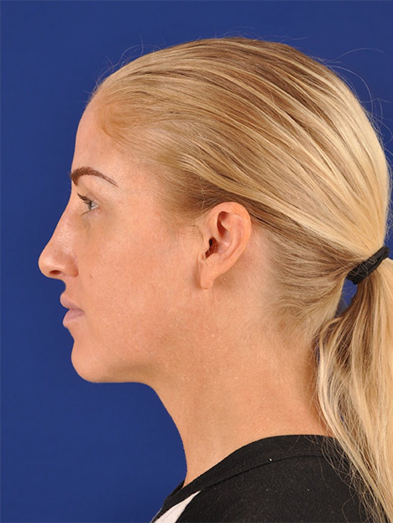Female Rhinoplasty Before & After Gallery - Patient 17363995 - Image 5