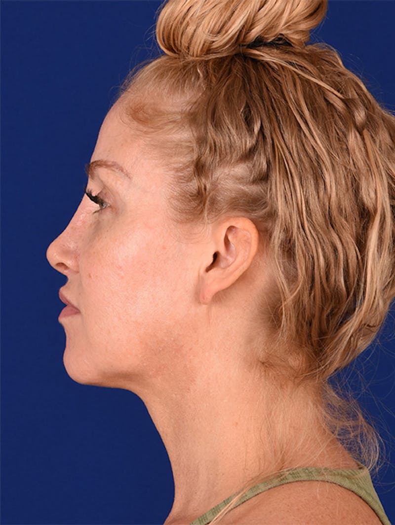 Female Rhinoplasty Before & After Gallery - Patient 17363995 - Image 6