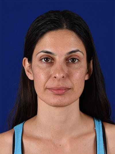 Female Rhinoplasty Before & After Gallery - Patient 17365734 - Image 1