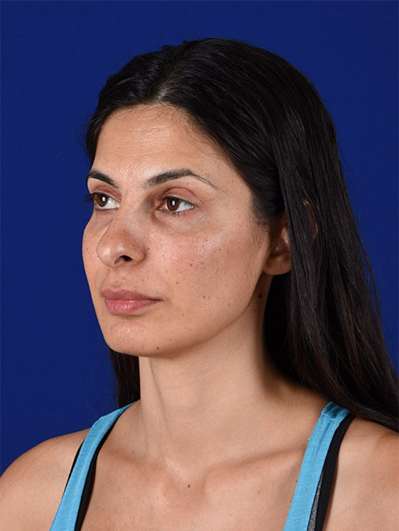 Female Rhinoplasty Before & After Gallery - Patient 17365734 - Image 3