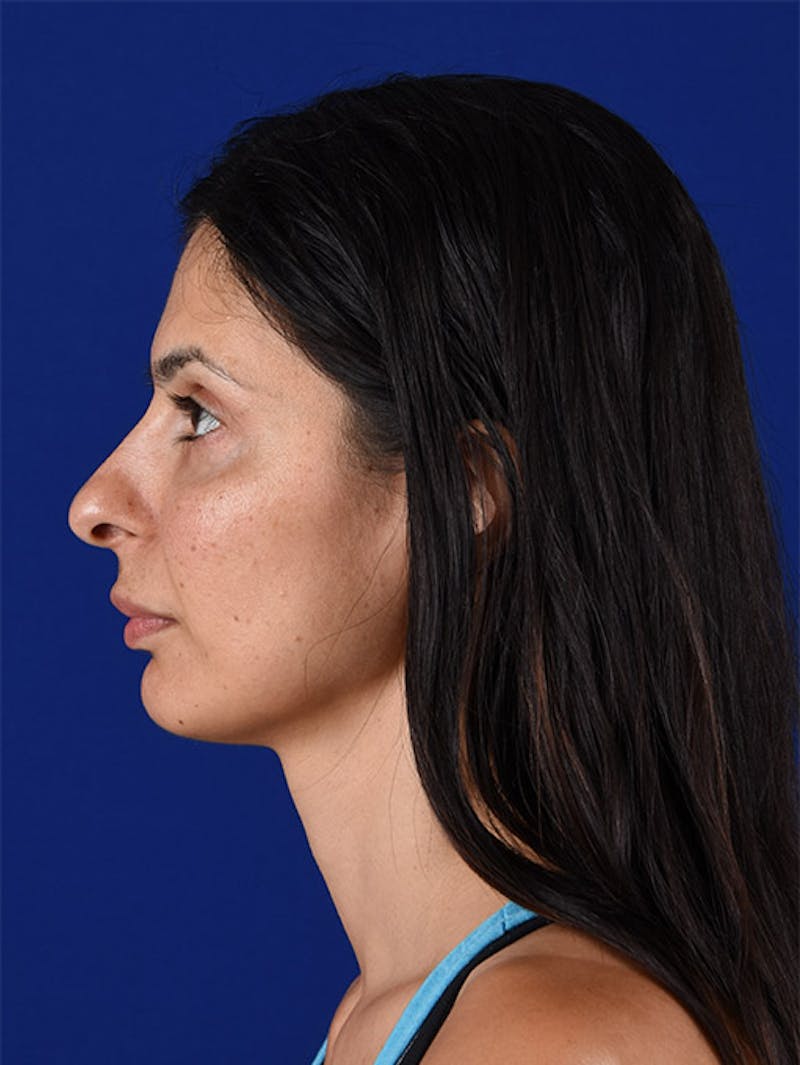 Female Rhinoplasty Before & After Gallery - Patient 17365734 - Image 5