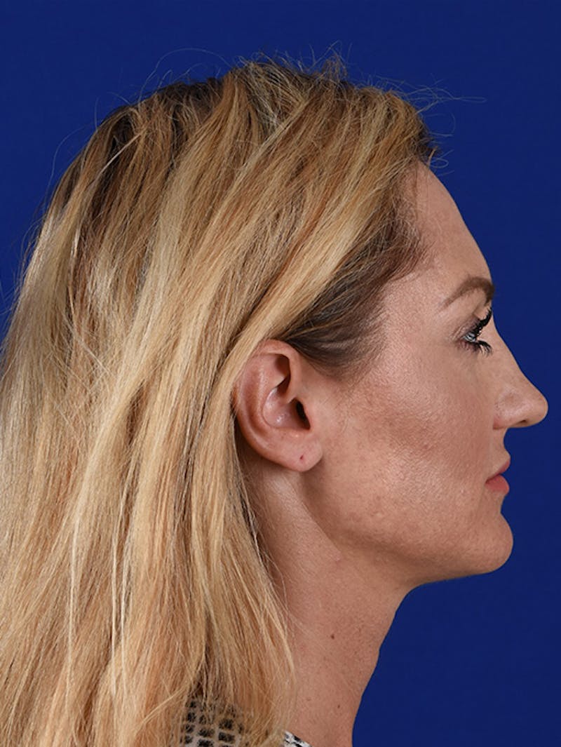 Female Rhinoplasty Before & After Gallery - Patient 17365736 - Image 5