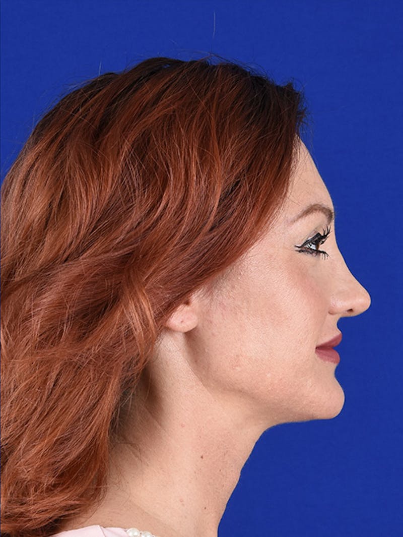 Female Rhinoplasty Before & After Gallery - Patient 17365736 - Image 6