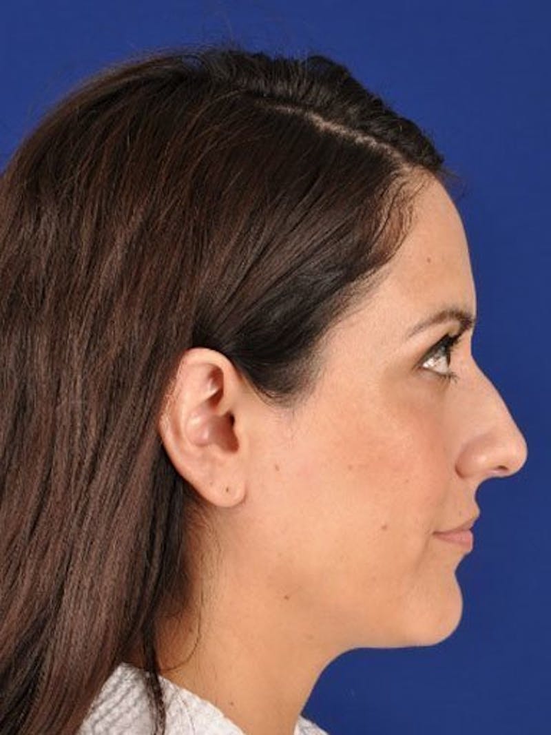 Female Rhinoplasty Before & After Gallery - Patient 17365737 - Image 3