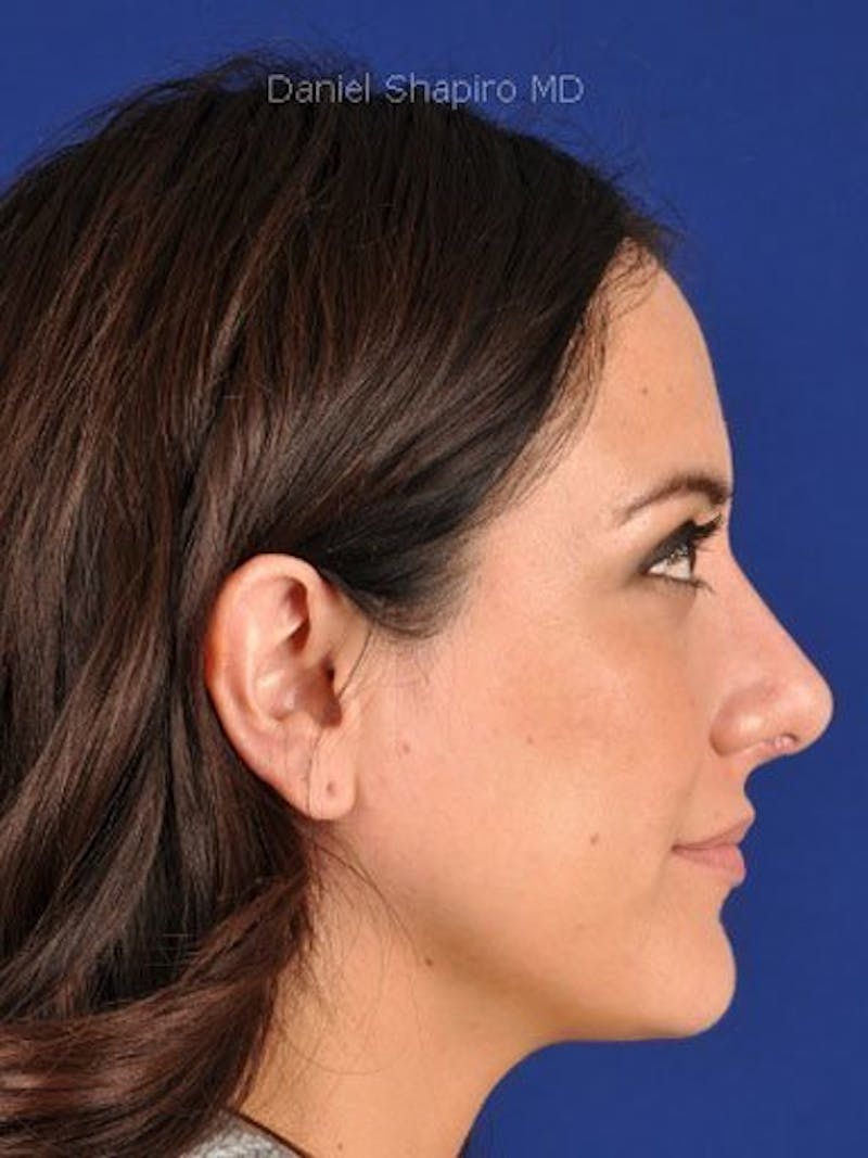 Female Rhinoplasty Before & After Gallery - Patient 17365737 - Image 4