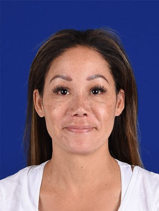 Female Rhinoplasty Before & After Gallery - Patient 17365739 - Image 2