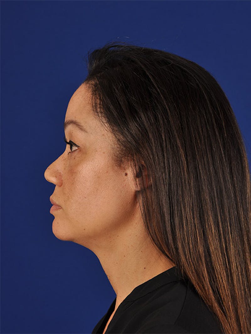 Female Rhinoplasty Before & After Gallery - Patient 17365739 - Image 5