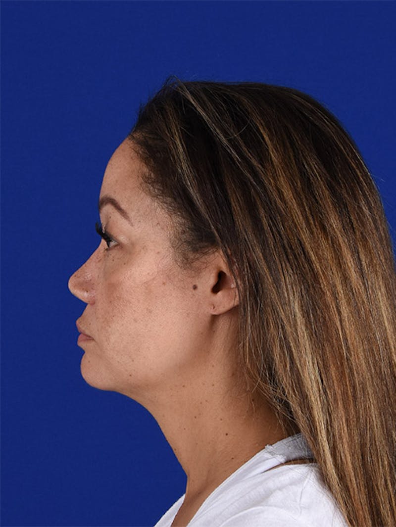 Female Rhinoplasty Before & After Gallery - Patient 17365739 - Image 6