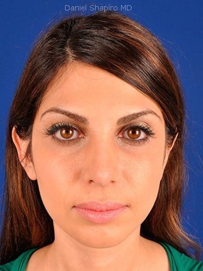 Female Rhinoplasty Before & After Gallery - Patient 17365740 - Image 2