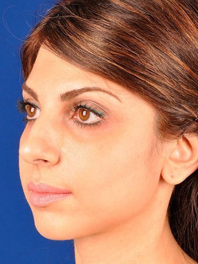Female Rhinoplasty Before & After Gallery - Patient 17365740 - Image 3