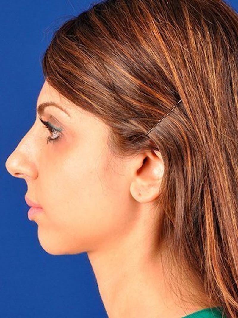 Female Rhinoplasty Before & After Gallery - Patient 17365740 - Image 5