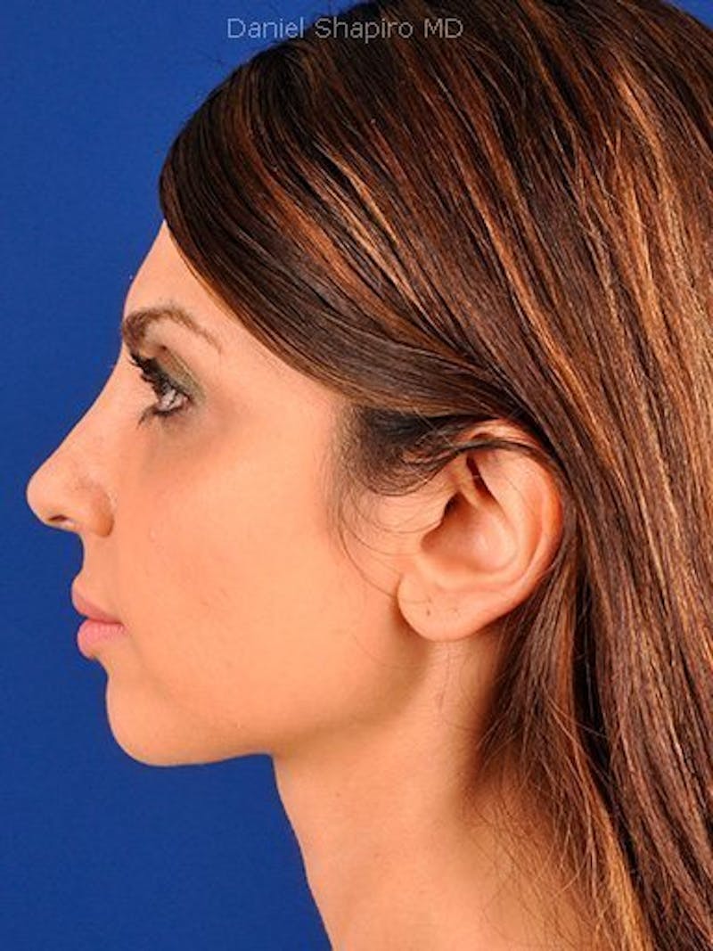 Female Rhinoplasty Before & After Gallery - Patient 17365740 - Image 6
