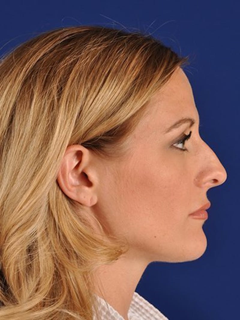 Female Rhinoplasty Before & After Gallery - Patient 17365741 - Image 5