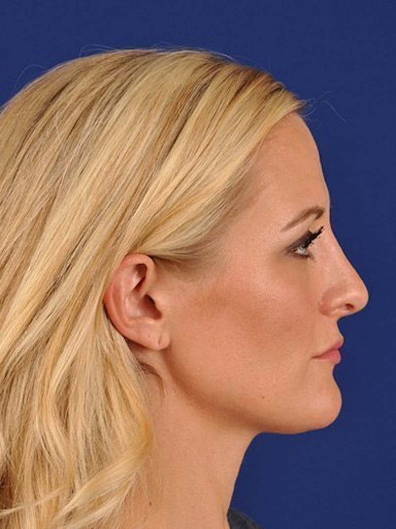 Female Rhinoplasty Before & After Gallery - Patient 17365741 - Image 6