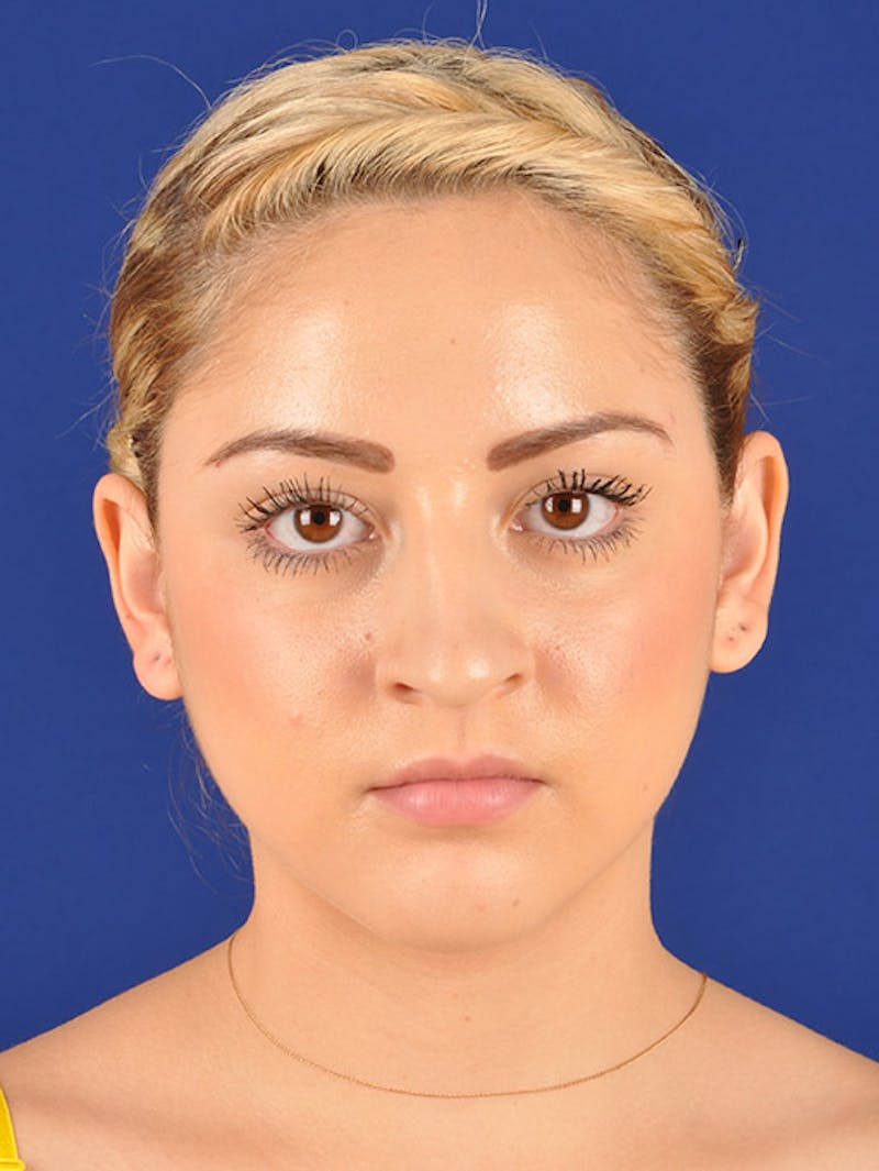 Female Rhinoplasty Before & After Gallery - Patient 17365743 - Image 1