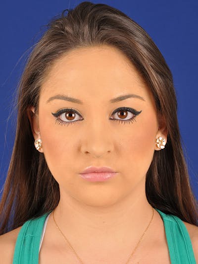 Female Rhinoplasty Before & After Gallery - Patient 17365743 - Image 2