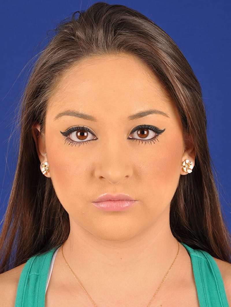 Female Rhinoplasty Before & After Gallery - Patient 17365743 - Image 2