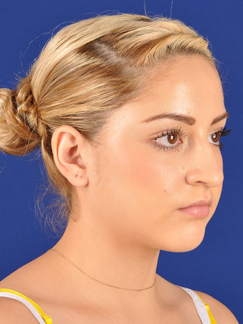 Female Rhinoplasty Before & After Gallery - Patient 17365743 - Image 3