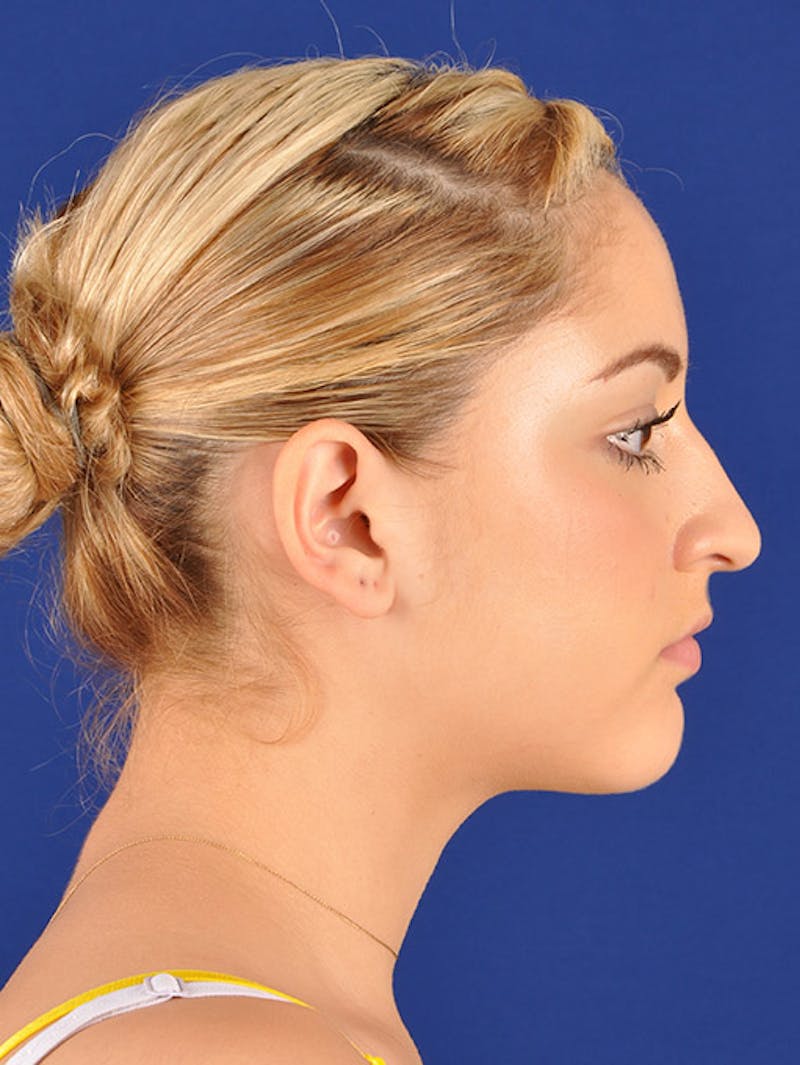 Female Rhinoplasty Before & After Gallery - Patient 17365743 - Image 5