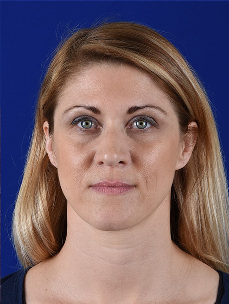 Female Rhinoplasty Before & After Gallery - Patient 17365744 - Image 1