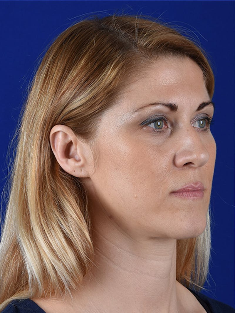 Female Rhinoplasty Before & After Gallery - Patient 17365744 - Image 3
