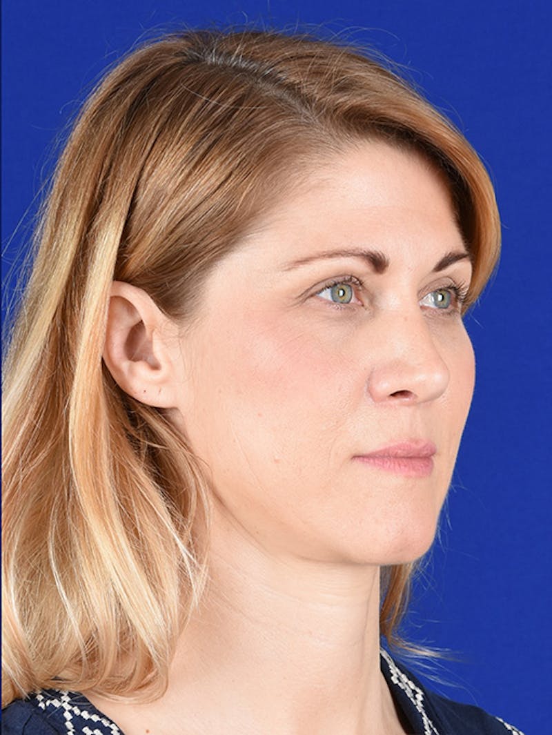 Female Rhinoplasty Before & After Gallery - Patient 17365744 - Image 4