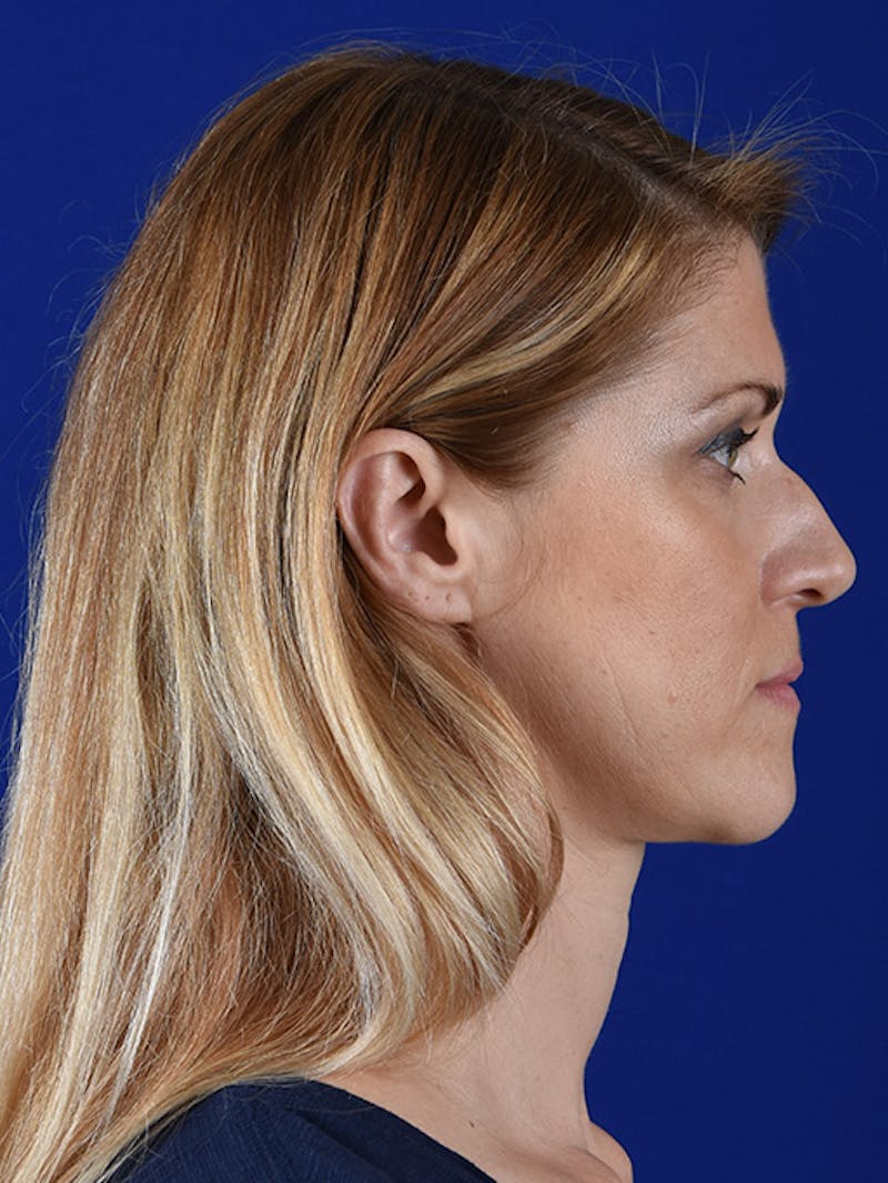 Female Rhinoplasty Before & After Gallery - Patient 17365744 - Image 5