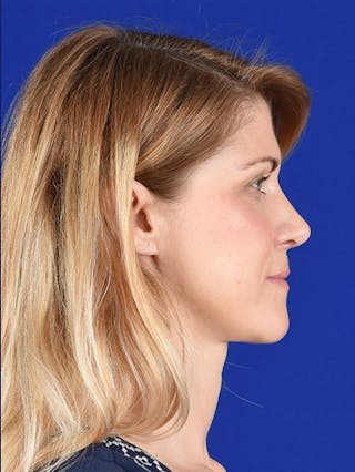 Female Rhinoplasty Before & After Gallery - Patient 17365744 - Image 6