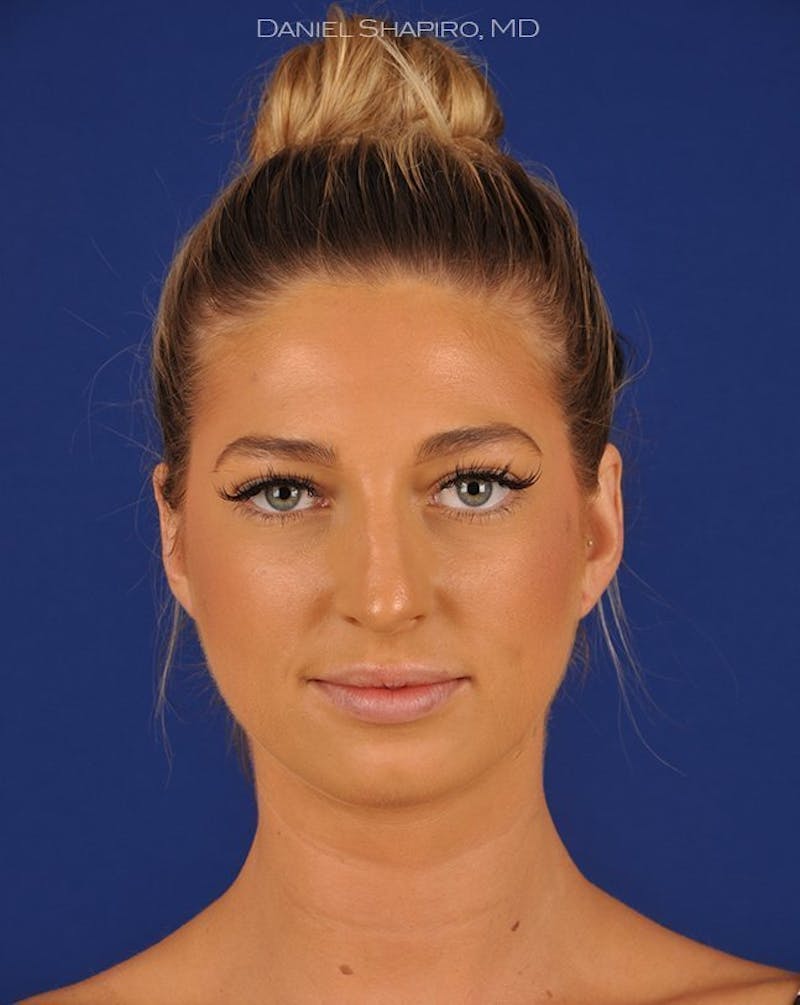 Female Rhinoplasty Before & After Gallery - Patient 17365746 - Image 1