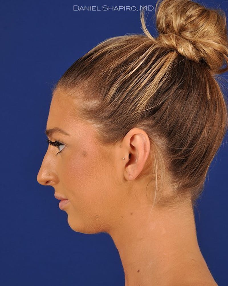 Female Rhinoplasty Before & After Gallery - Patient 17365746 - Image 5