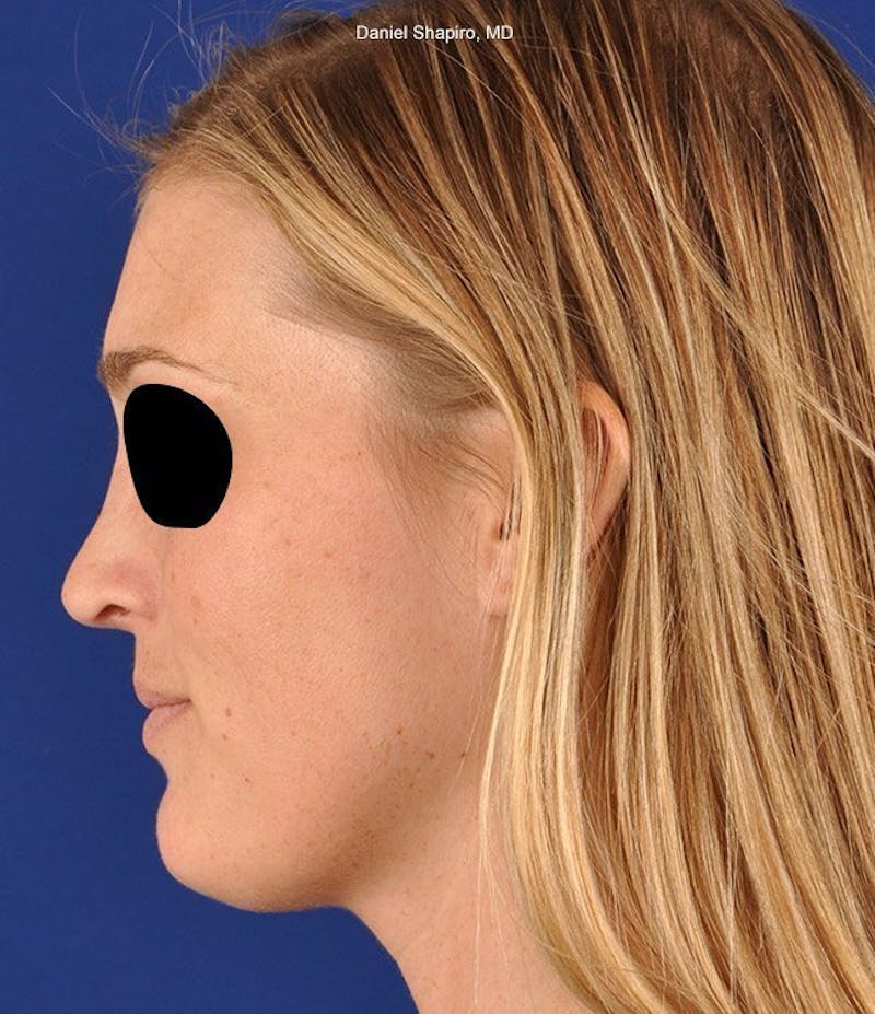 Female Rhinoplasty Before & After Gallery - Patient 17365749 - Image 6