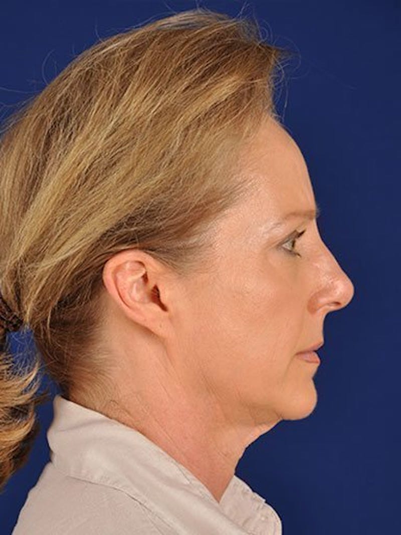 Female Rhinoplasty Before & After Gallery - Patient 17365752 - Image 5