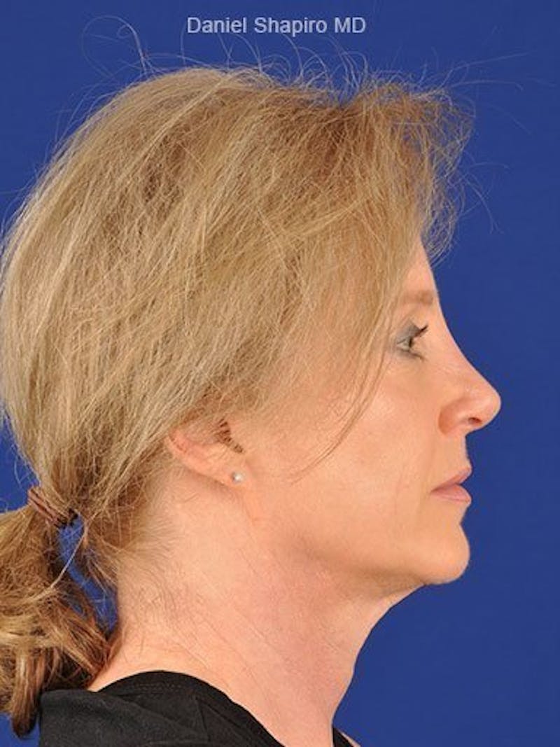 Female Rhinoplasty Before & After Gallery - Patient 17365752 - Image 6