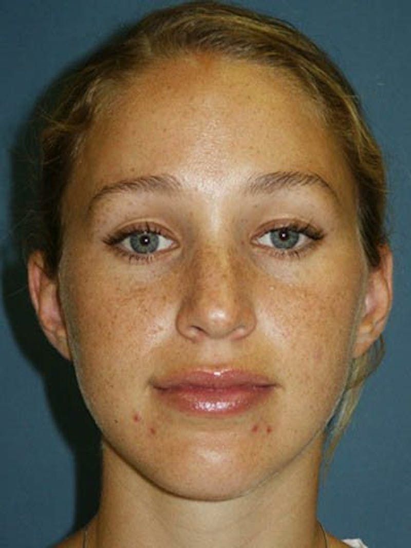 Female Rhinoplasty Before & After Gallery - Patient 17365753 - Image 1