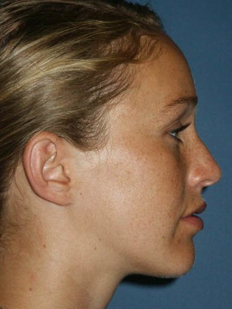 Female Rhinoplasty Before & After Gallery - Patient 17365753 - Image 3