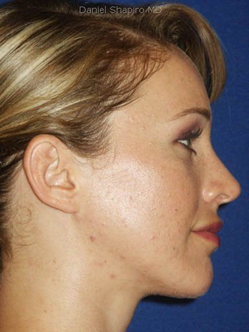 Female Rhinoplasty Before & After Gallery - Patient 17365753 - Image 4